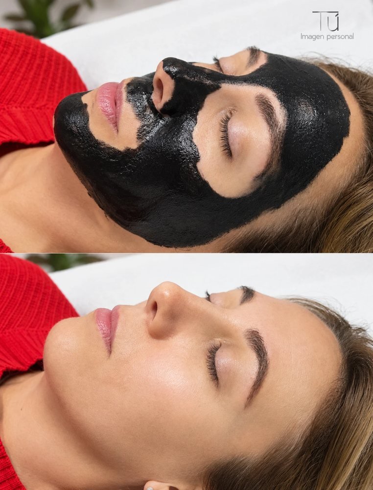 Limpieza facial con carbon peeling, antes y después, en TÚ Imagen Personal