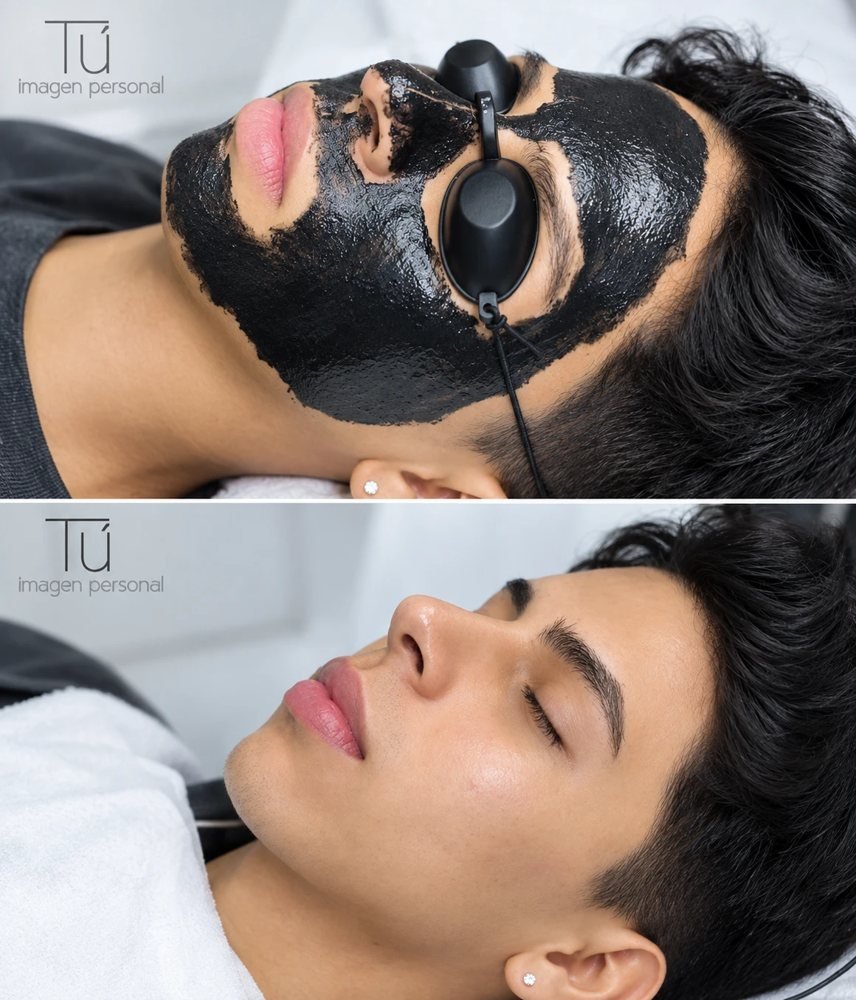 Carbon peeling facial con protección ocular, antes y después