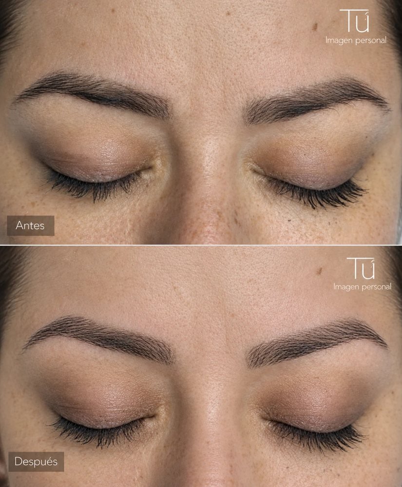 Resultado en cejas tras la remoción de pigmento con láser, antes y después