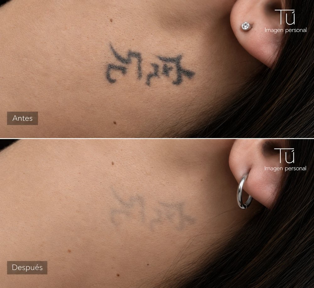 Remoción de un tatuaje con láser en TÚ Imagen Personal, antes y después